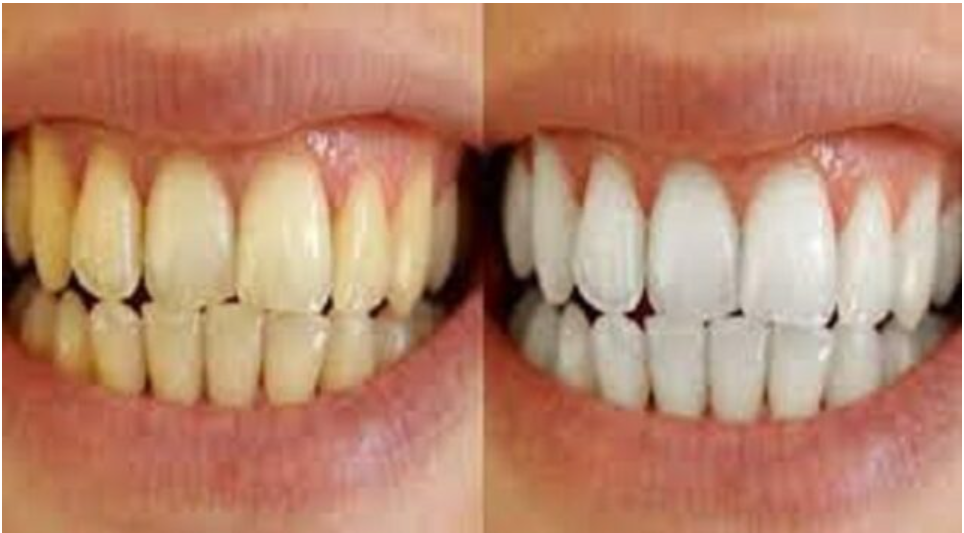 Gigi Kuning Padahal Rajin Sikat Gigi? Ini Penyebab dan Solusinya